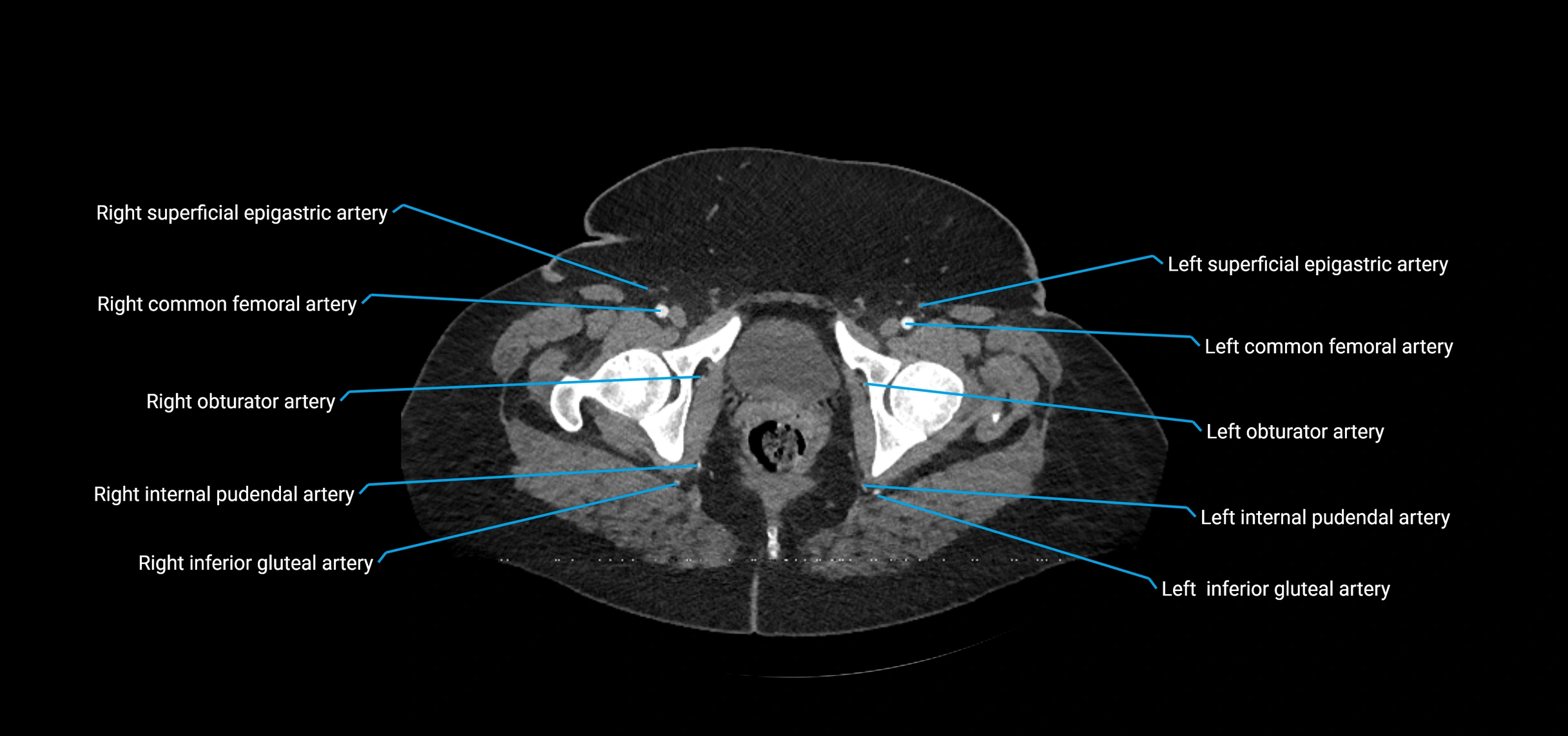 CTA abdomen axial cross sectional anatomy labelled image_252 (2).webp